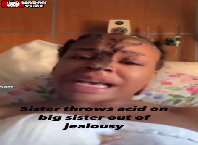 Video :Her sister splashed acid in her face, leaving her disfigured (Warning - frightening)